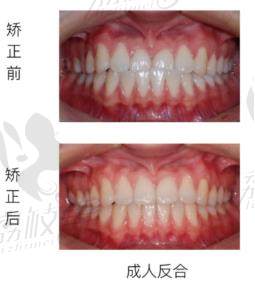 荔枝美：上海雅悦齿科成人反合矫正案例
