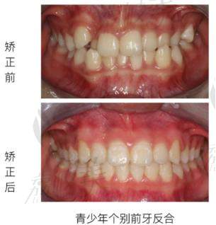 荔枝美：上海雅悦齿科青少年个别前牙反合矫正案例