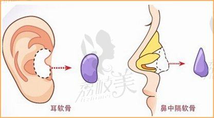 西安艺星整形假体隆鼻的效果自然吗？费用是多少？