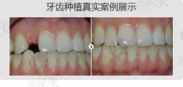 西安雁塔海涛口腔医院赵海涛院长牙齿种植手术案例