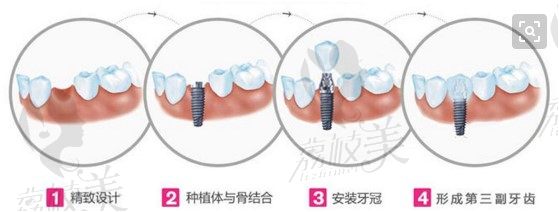 种植牙过程