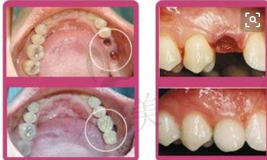 种植牙案例