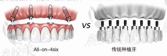 半口牙缺失-海涛口腔All-on-4即刻负重技术