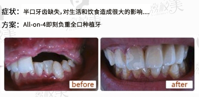 西安雁塔海涛口腔医院赵海涛院长半口种植牙案例分享：