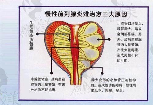 前列腺炎难治的原因jpg