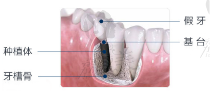 西安海涛口腔赵海涛院长告诉你种植牙选择哪种材料