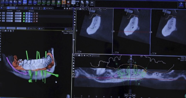 数字化3D导板种植牙技术、口腔检查
