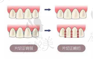 牙齒片切<span style=