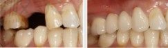 刘女士牙齿缺失种植前后对比图