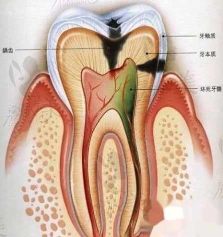 广州圣贝蔡菁菁讲解根管治疗后牙神经还在吗?还需做牙冠吗?