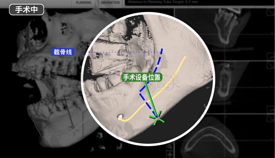 韩国id双颚导航手术中