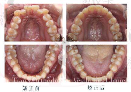 西安赛德口腔牙齿矫正案例.jpg