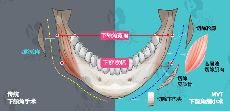 传统下颌角手术