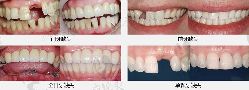 深圳美莱口腔种植牙案例分享