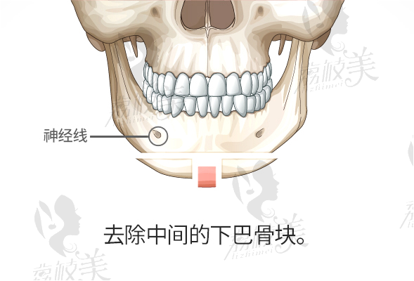 鉆石截骨術+下頜角縮小術，示意圖