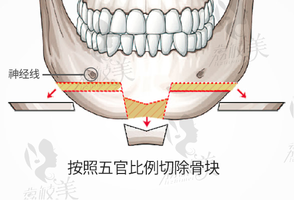 钻石截骨术+下颌角缩小术