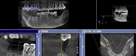 三维CT牙片出方案