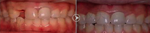 缪思亮单颗牙齿缺失微创即刻种植案例