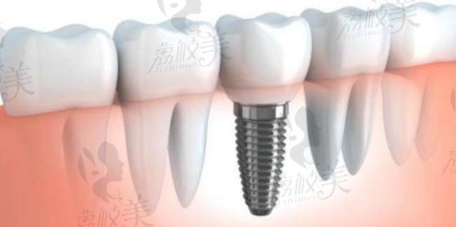 荔枝美：石家庄中诺口腔医院张伟医生单科牙缺失种植示意图