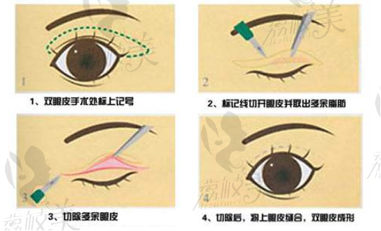 单眼皮去割双眼皮.png?x-oss-process=style/lzmei