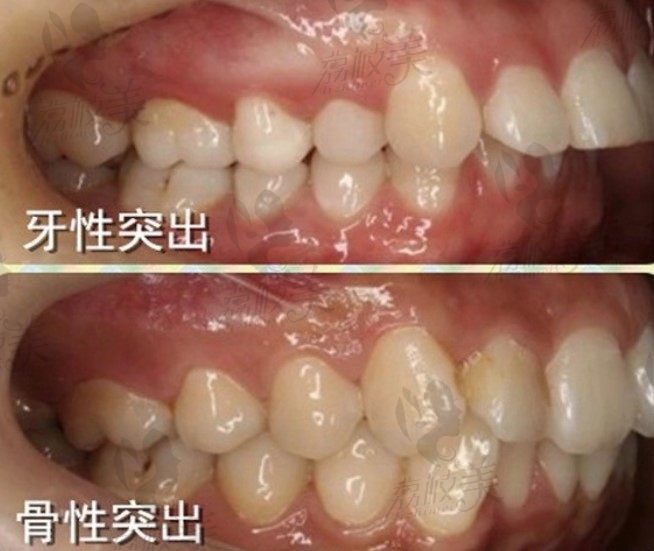 荔枝美：深圳吉华登特口腔门诊部牙性龅牙和骨性龅牙图