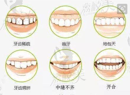 常见的需要拔牙矫正的情况