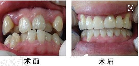 患者拔除了4颗正畸牙矫正