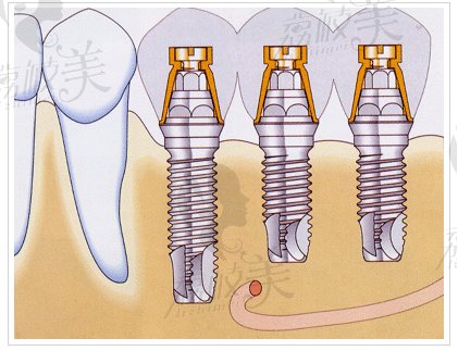 1592813虎门拜尔口腔门诊部--微创生物种植牙