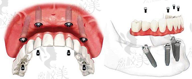 虎门拜尔口腔门诊部--微创生物种植牙