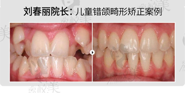 九龙口腔门诊部(瀍河店)刘春丽院长儿童错颌畸形的治疗案例
