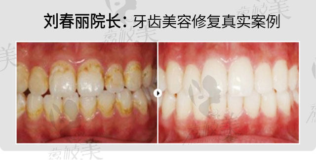 九龙口腔门诊部(瀍河店)刘春丽院长牙齿美容修复治疗案例