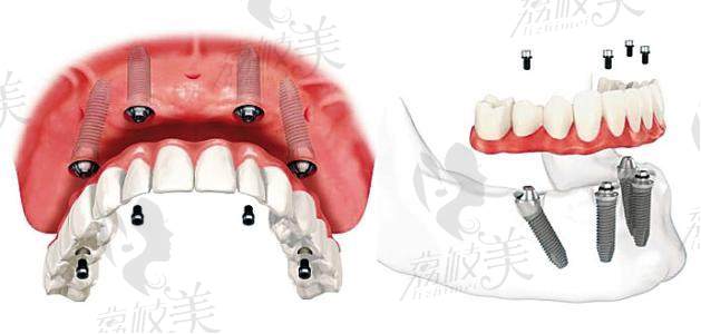 郑淑敏院长的3D数字化种植牙