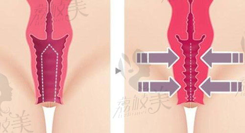 尹虎珠博士阴道缩阴手术与传统的阴道紧缩术区别