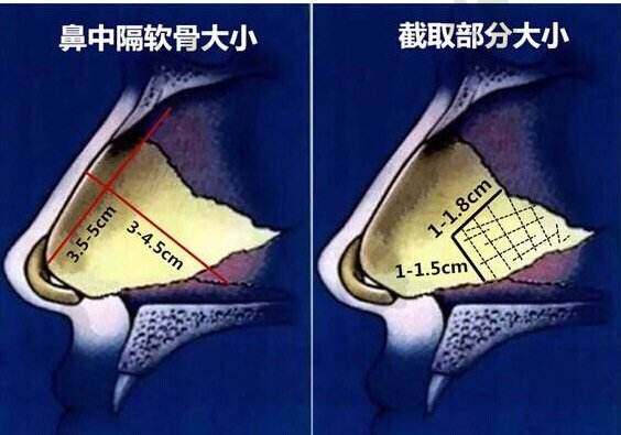 鼻中隔软骨在哪里