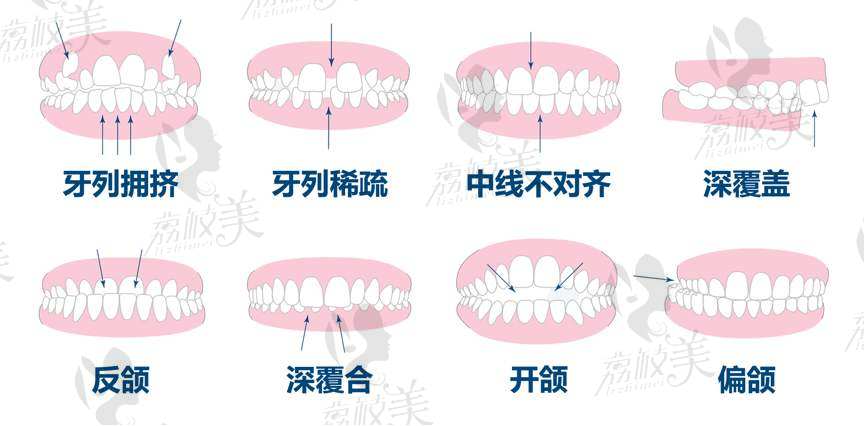 深圳美萊口腔韓旭院長(zhǎng)表示：牙齒畸形危害多，一口丑牙毀一生！