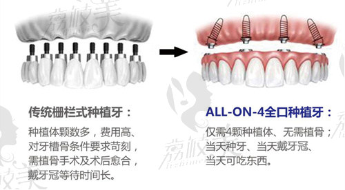 西安海涛口腔医院未央分院——“All-on-4半/全口种植牙一日重建术