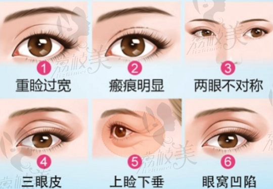 双眼皮失败类型.png?x-oss-process=style/lzmei