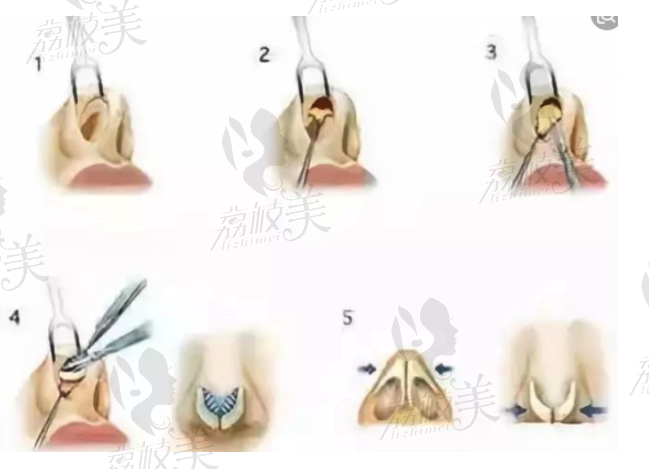 韩国鼻修复的材料，假体，自体软骨，膨体该怎么选？