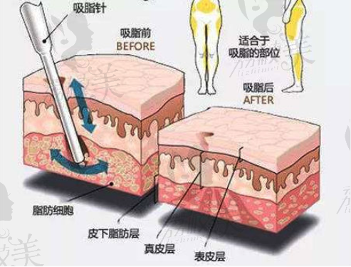 吸脂手术.png?x-oss-process=style/lzmei