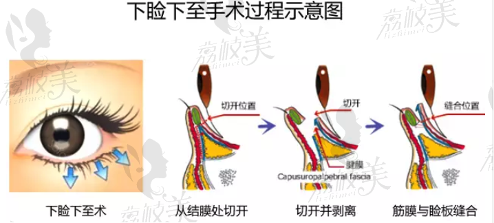 下睑下zhi手术.jpg?x-oss-process=style/lzmei