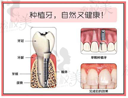 北京中诺口腔医院医生表示：种植牙主要由种植体、基台、牙冠三部分组成