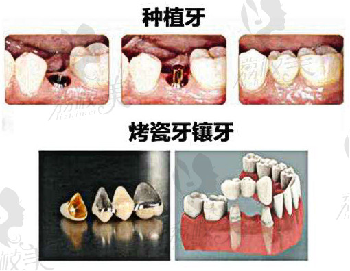 种植牙与镶牙对比哪个好？