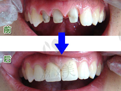 烤瓷牙-牙齿修复方式之一