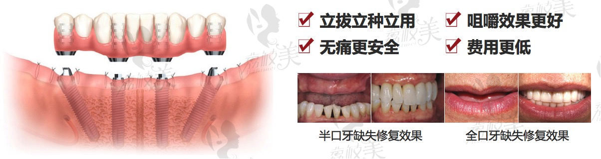 All-on-4即刻负重种植牙案例