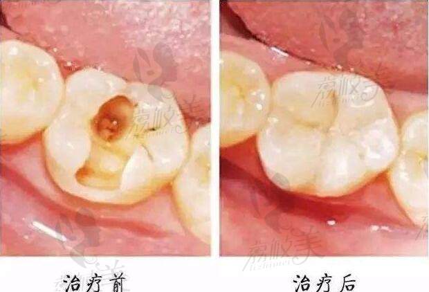 北京西尔口腔补牙案例