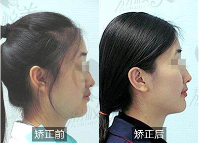 北京西尔口腔医院隐适美矫正案例侧面对比