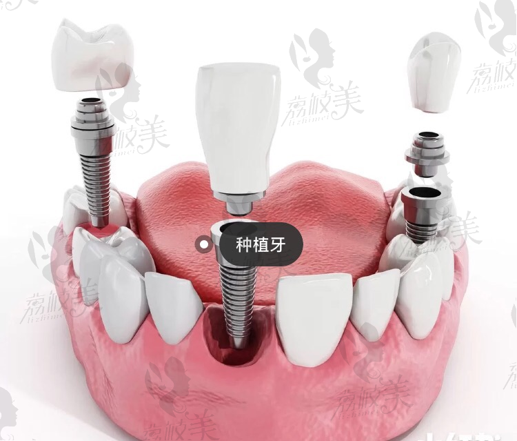 种植牙系统材料