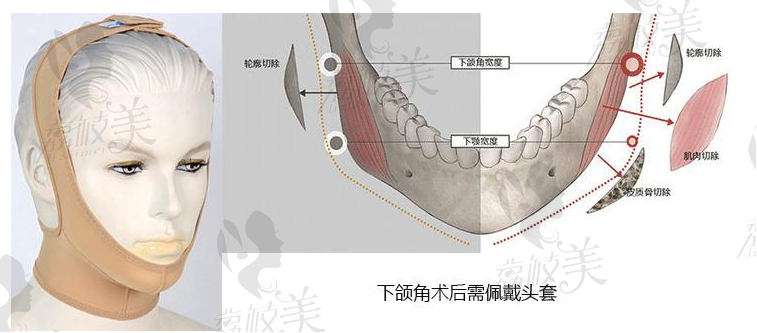 下颌角整形.png?x-oss-process=style/lzmei