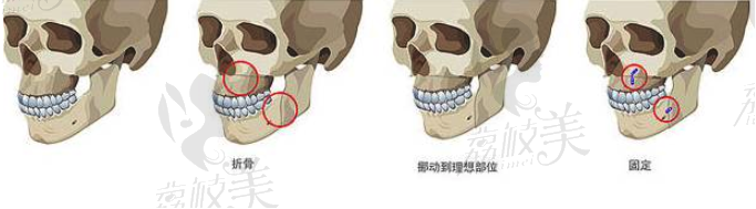 双鄂手术.png?x-oss-process=style/lzmei