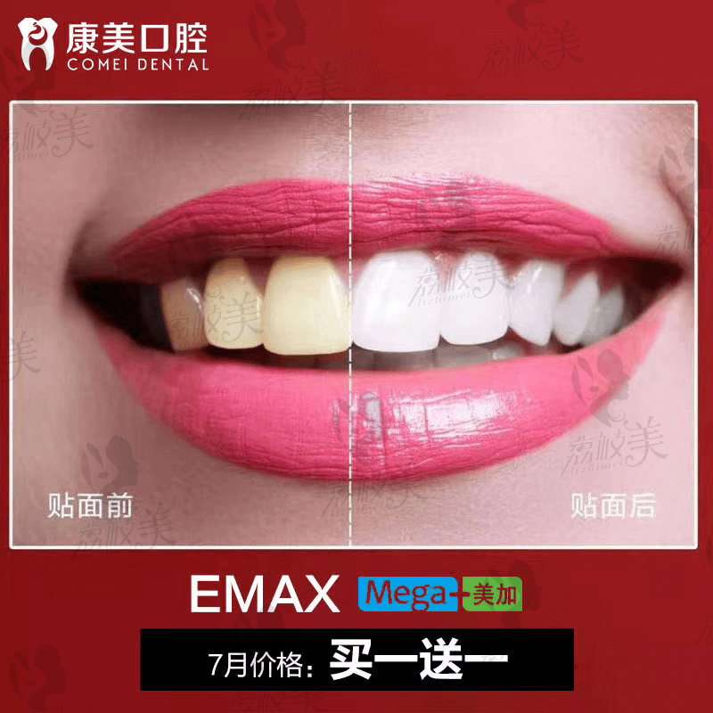 e-max全瓷贴面案例对比效果和价格标示